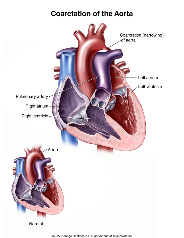 Coarctation of the Aorta: Illustration