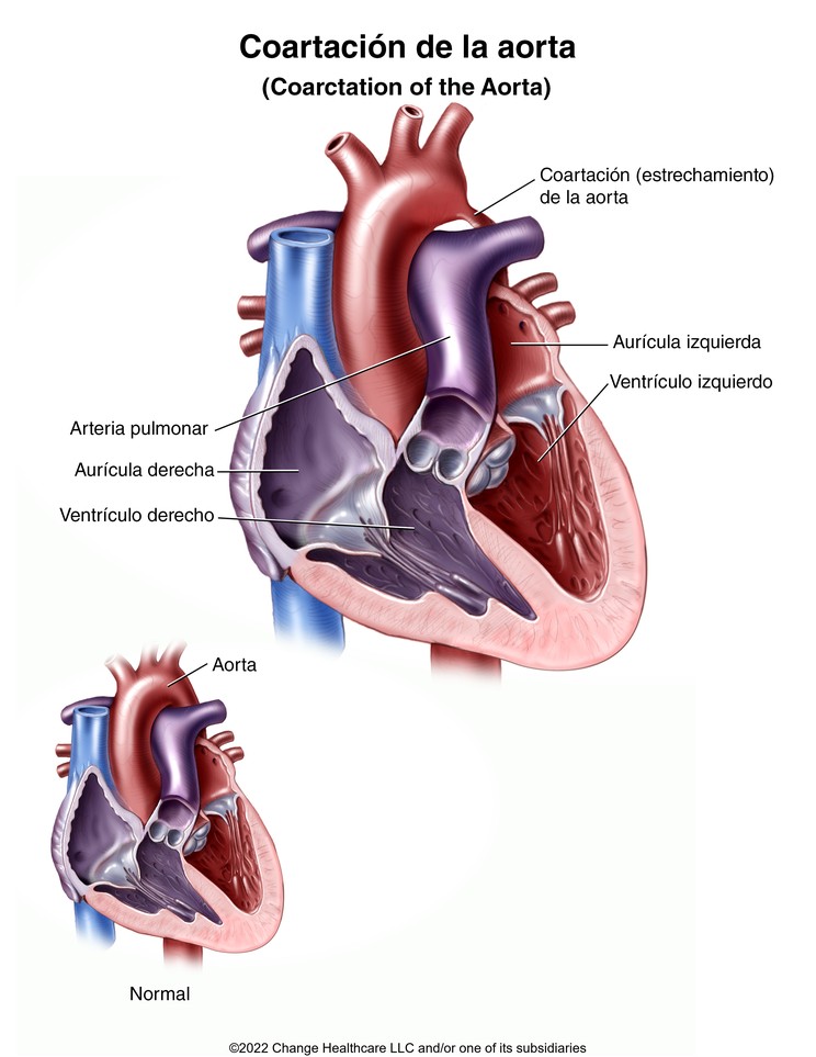 Coarctation of the Aorta: Illustration