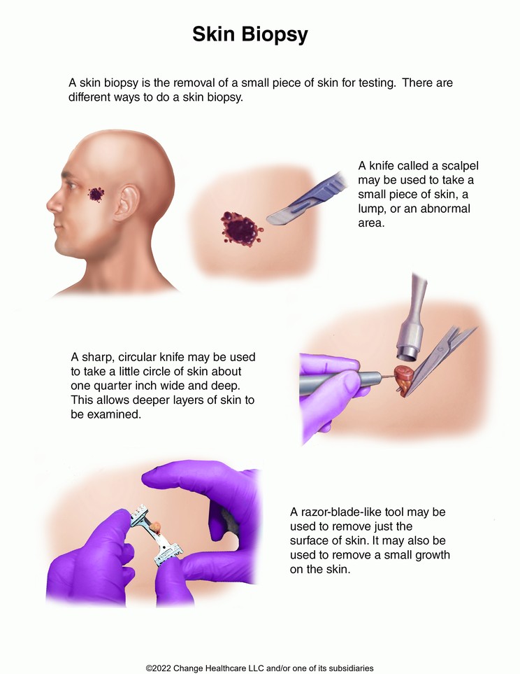 Skin Biopsy: Illustration