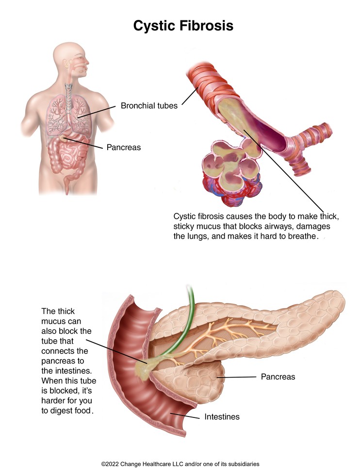 Cystic Fibrosis: Illustration
