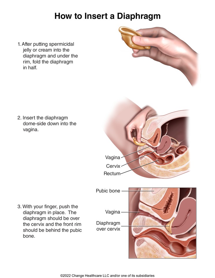 Diaphragm, How to Insert: Illustration