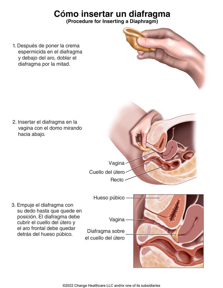 Diaphragm, How to Insert: Illustration