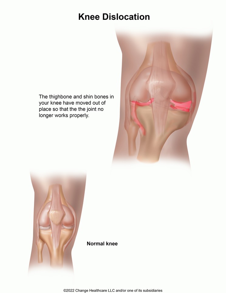 Knee Dislocation: Illustration