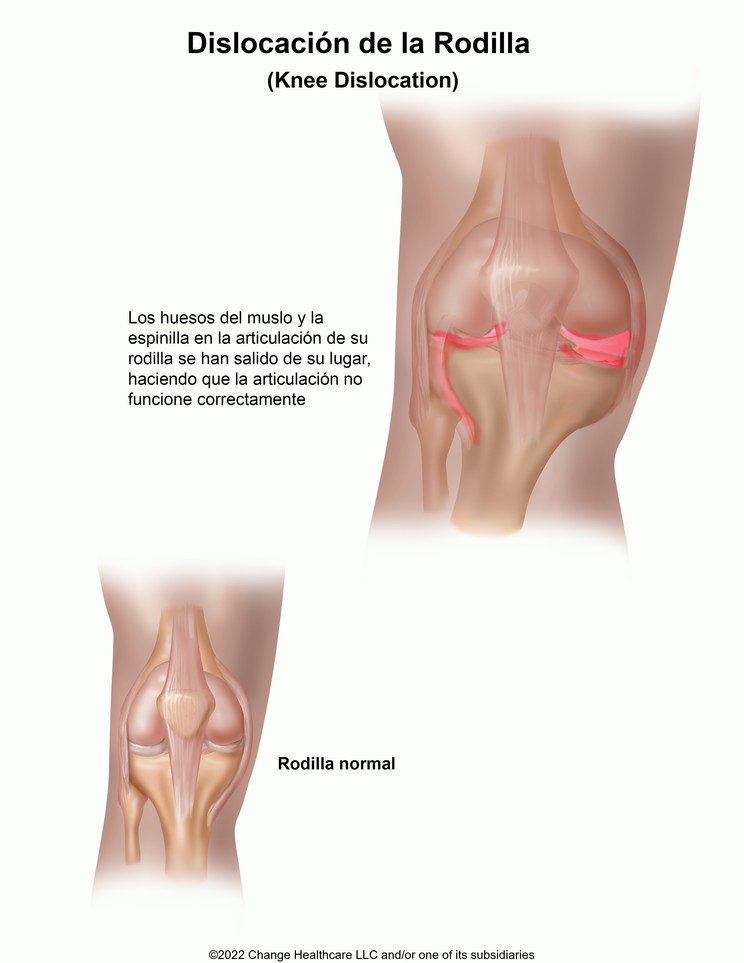 Knee Dislocation: Illustration