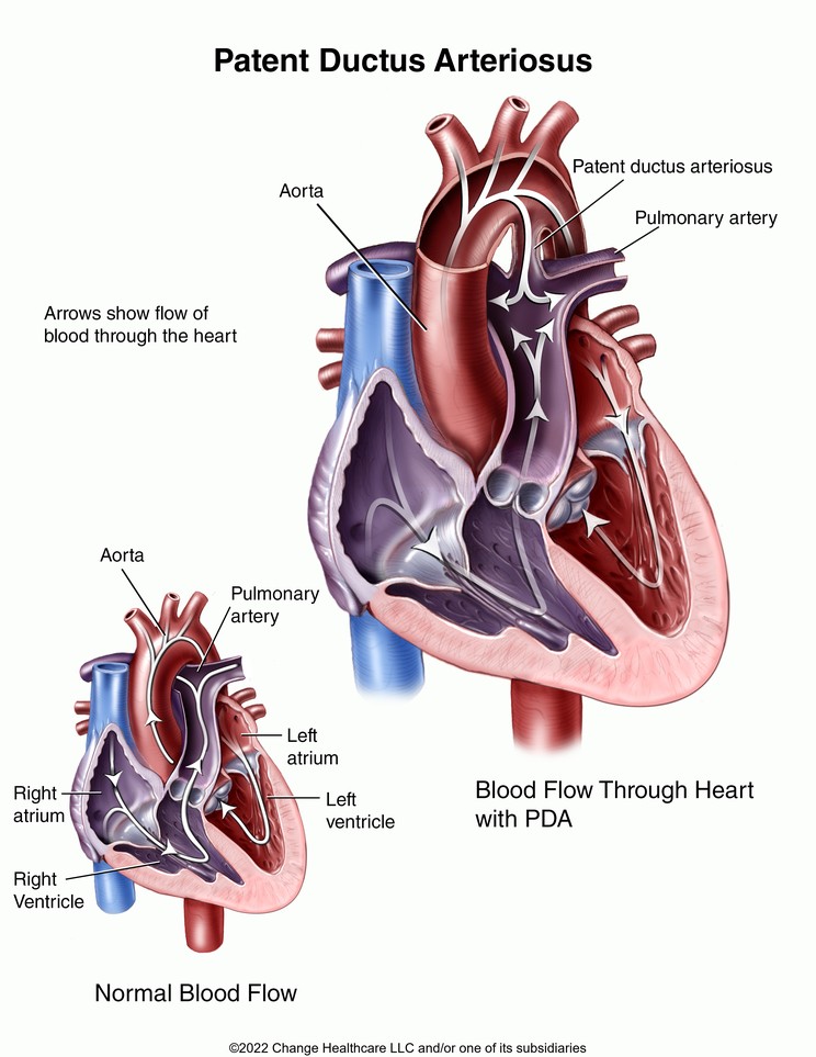 Patent Ductus Arteriosus: Illustration