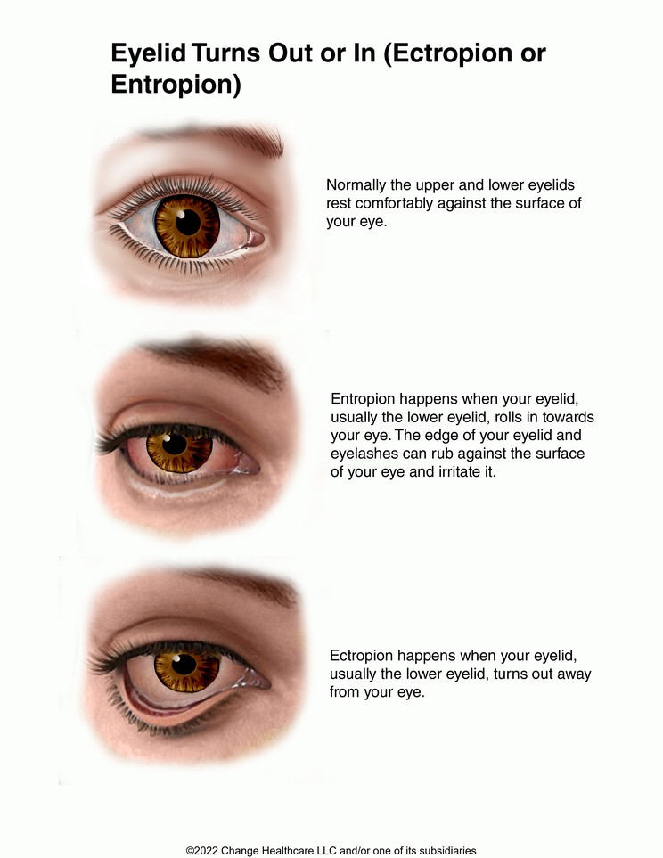 Eyelid Turns Out or In (Ectropion or Entropion): Illustration