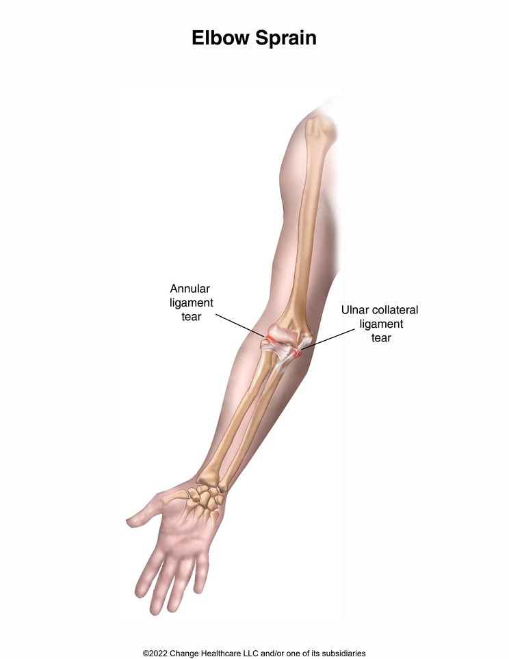 Elbow Sprain: Illustration