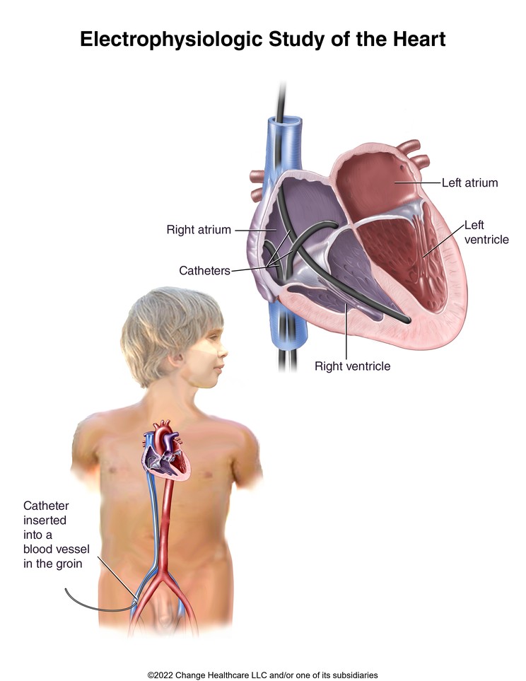Electrophysiologic Study (EPS): Illustration