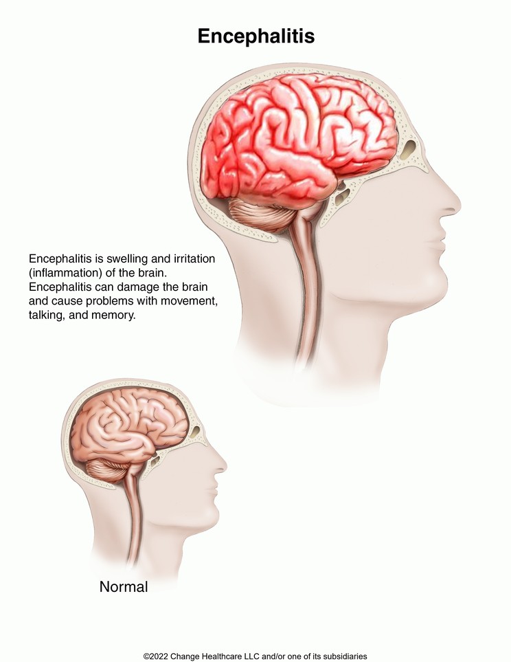 Encephalitis: Illustration