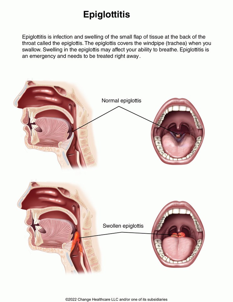 Epiglottitis: Illustration