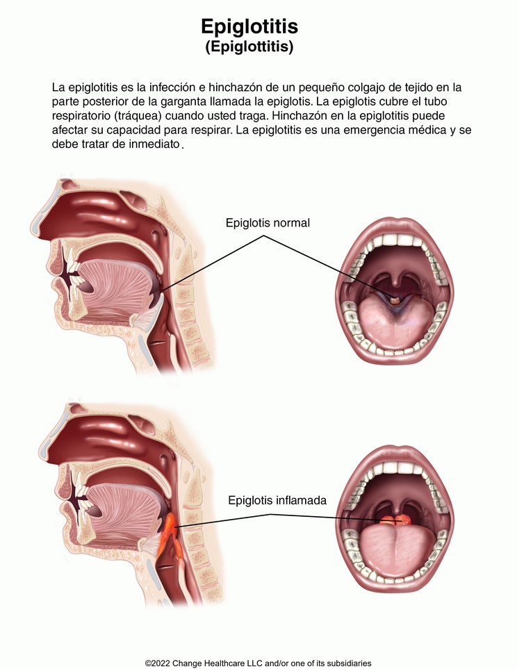 Epiglottitis: Illustration