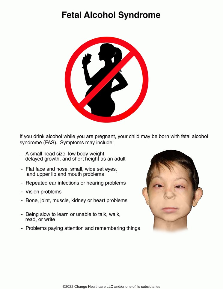 Fetal Alcohol Syndrome in Children: Illustration