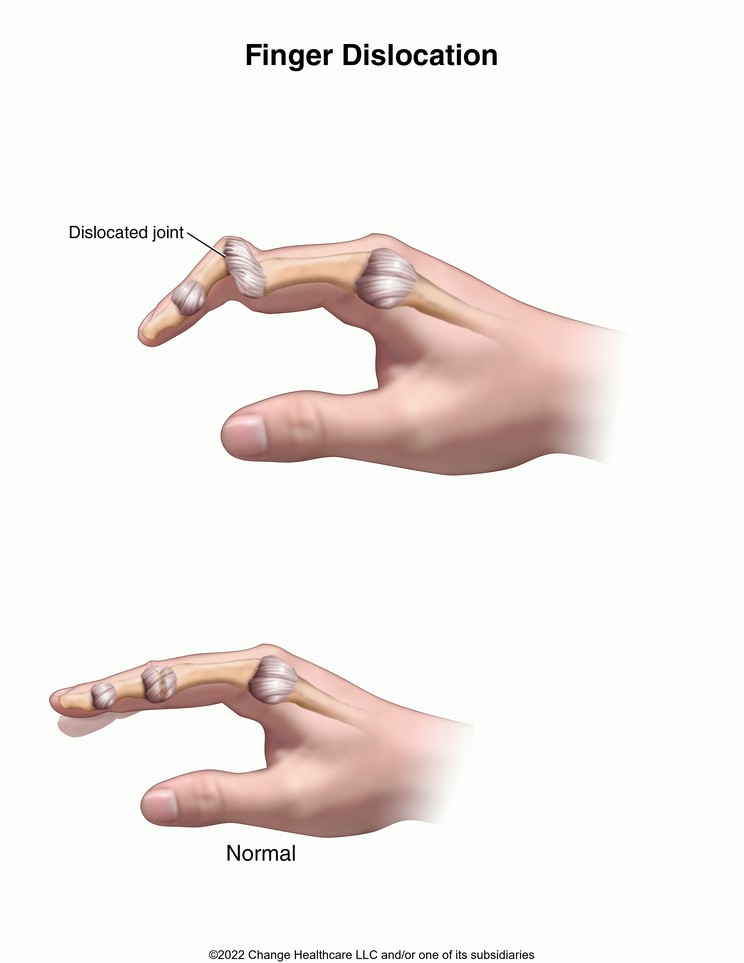 Finger Dislocation: Illustration