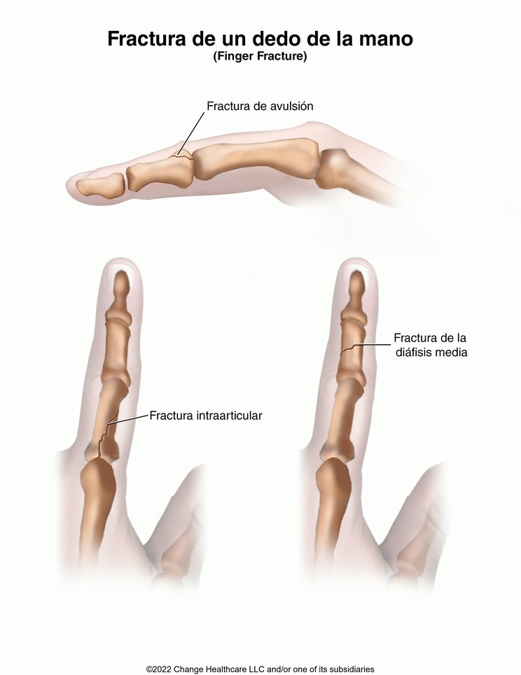Finger Fracture: Illustration