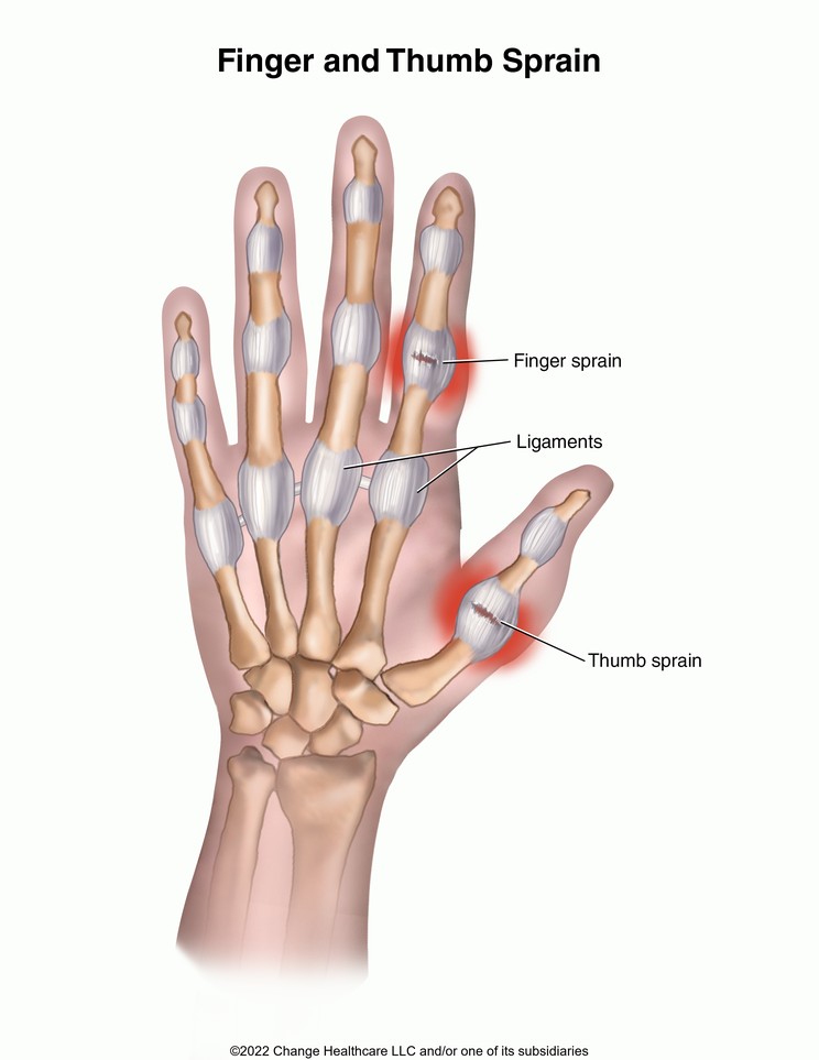 Finger and Thumb Sprain: Illustration
