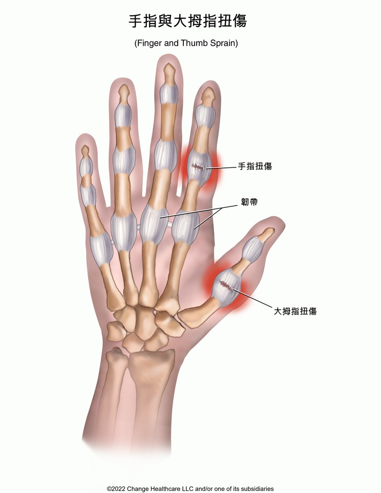 Finger and Thumb Sprain: Illustration