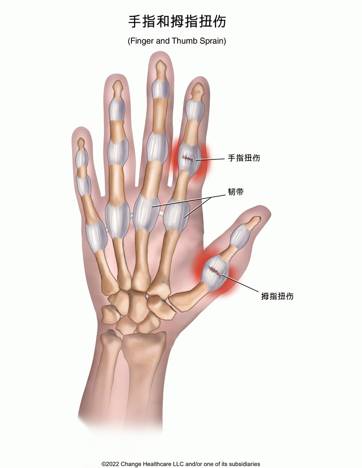 Finger and Thumb Sprain: Illustration