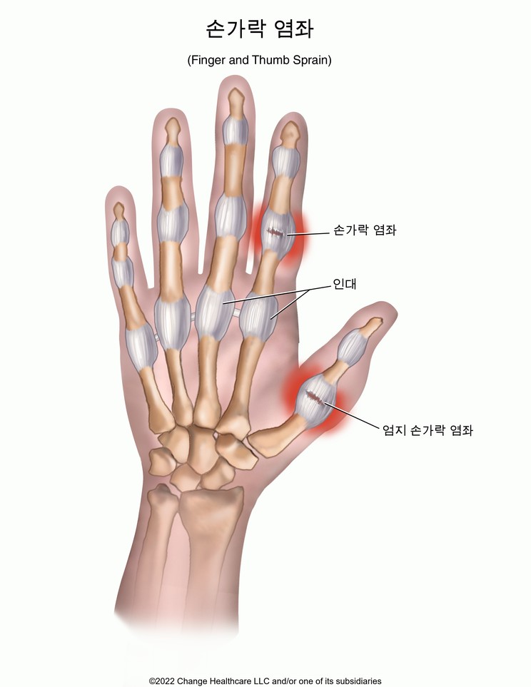 Finger and Thumb Sprain: Illustration