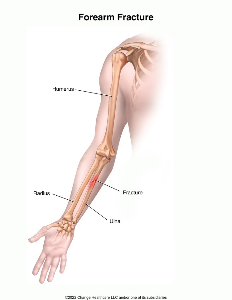 Forearm Fracture: Illustration