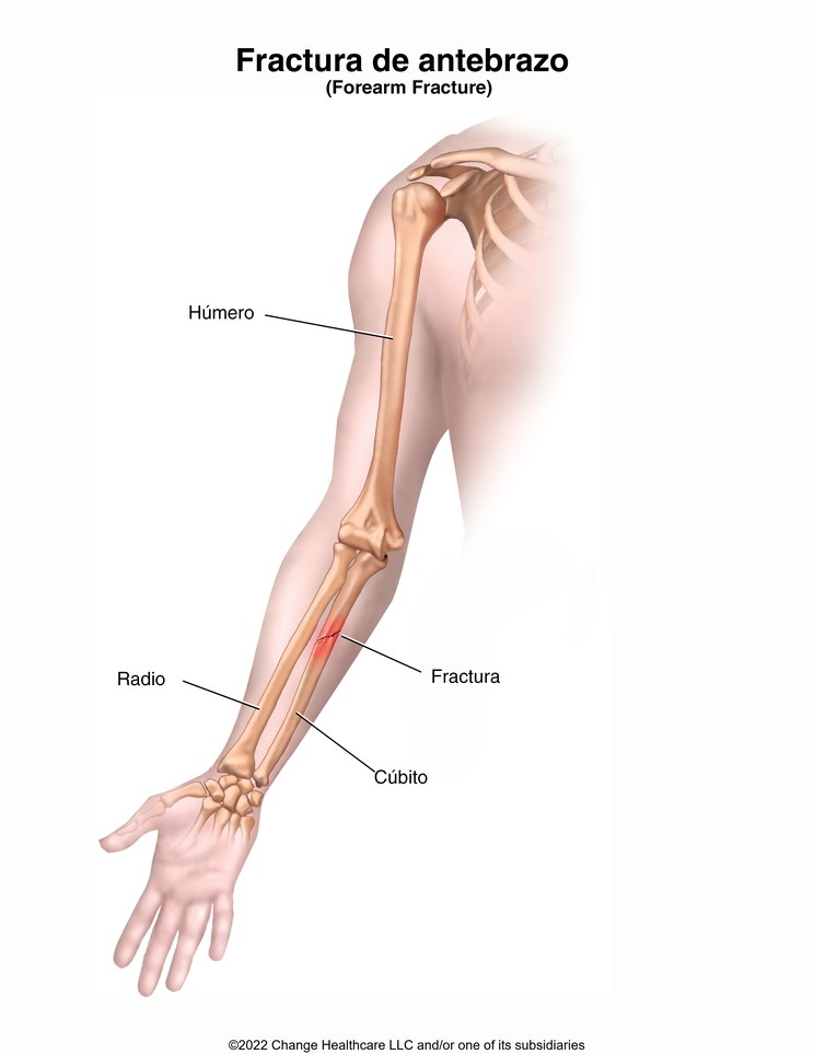 Forearm Fracture: Illustration
