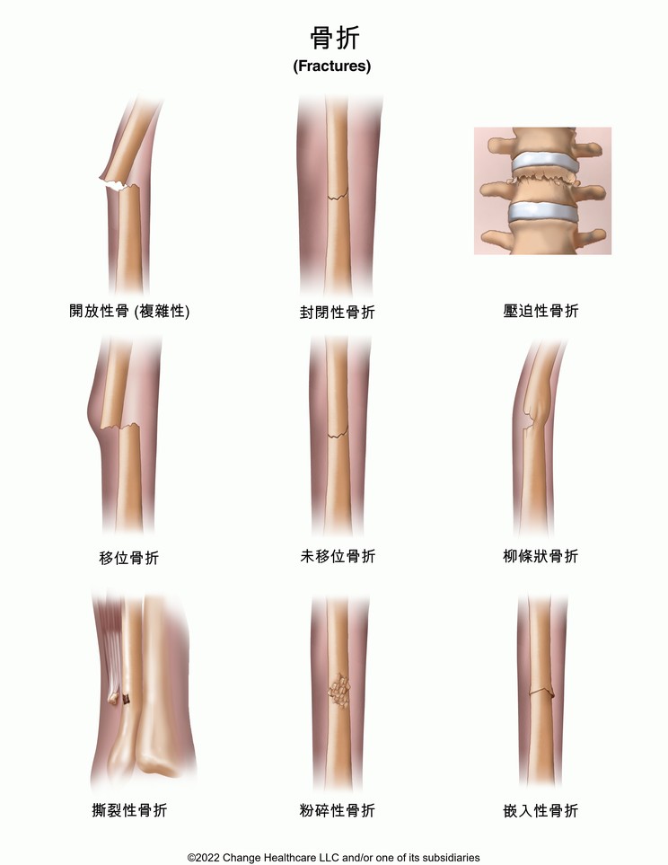 Fractures: Illustration