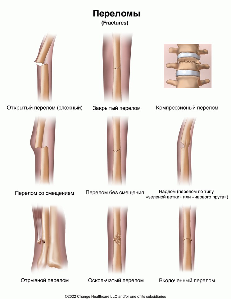 Fractures: Illustration