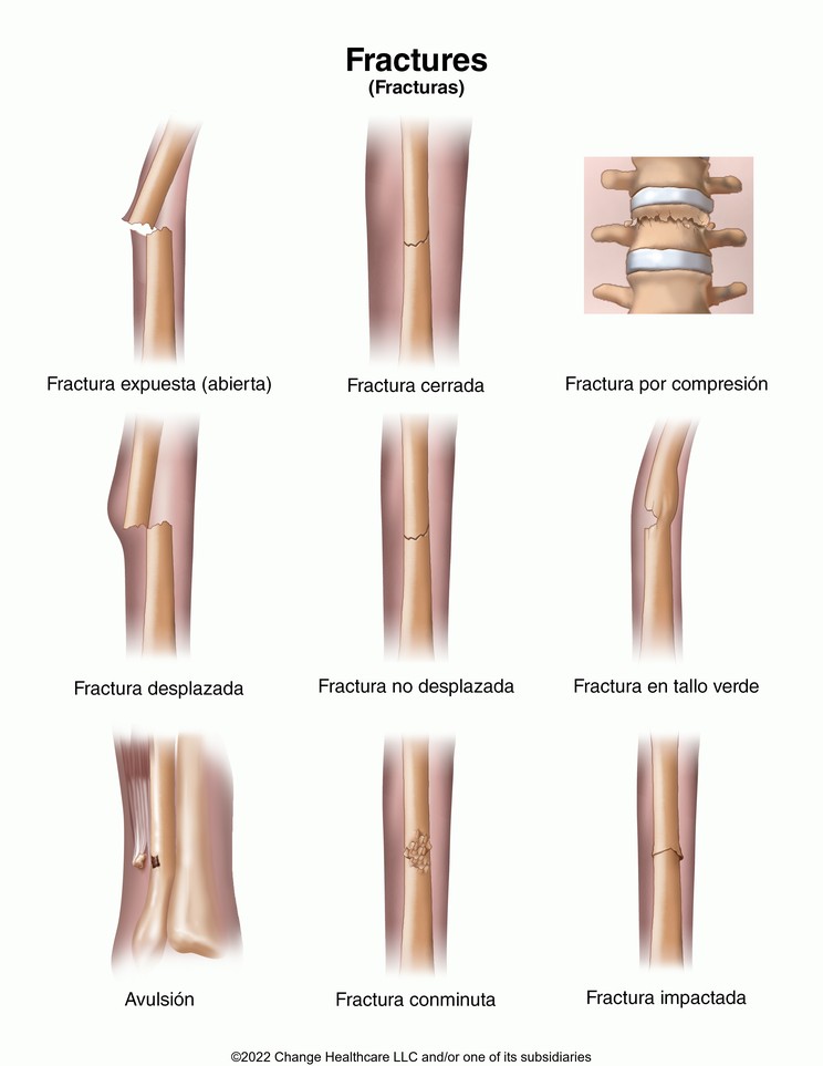 Fractures: Illustration