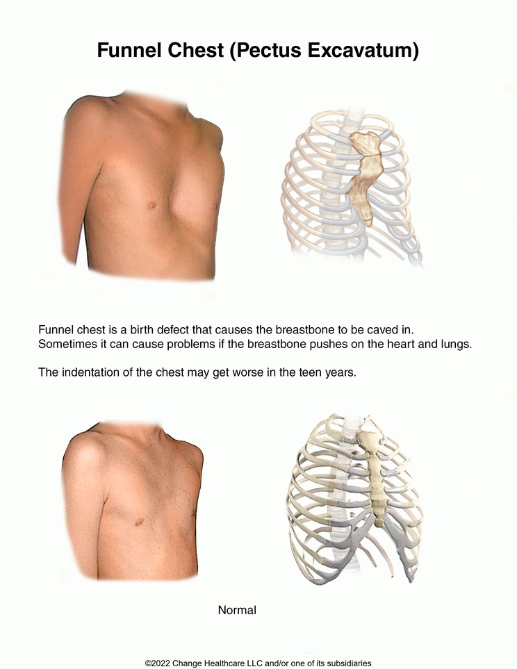 Funnel Chest: Illustration