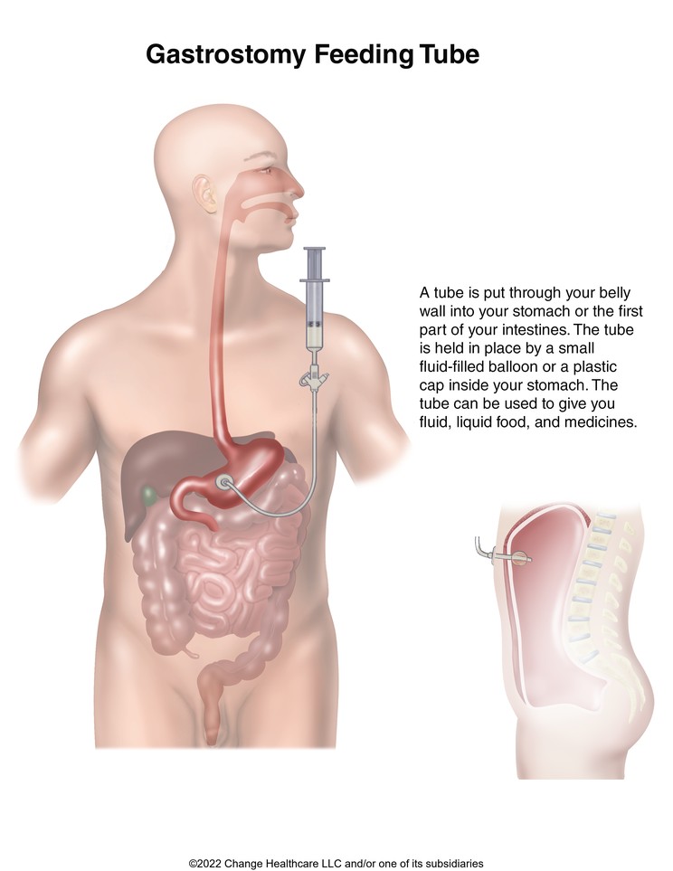 Gastrostomy Feeding Tube: Illustration