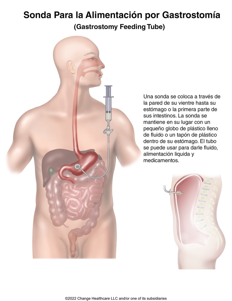 Gastrostomy Feeding Tube: Illustration
