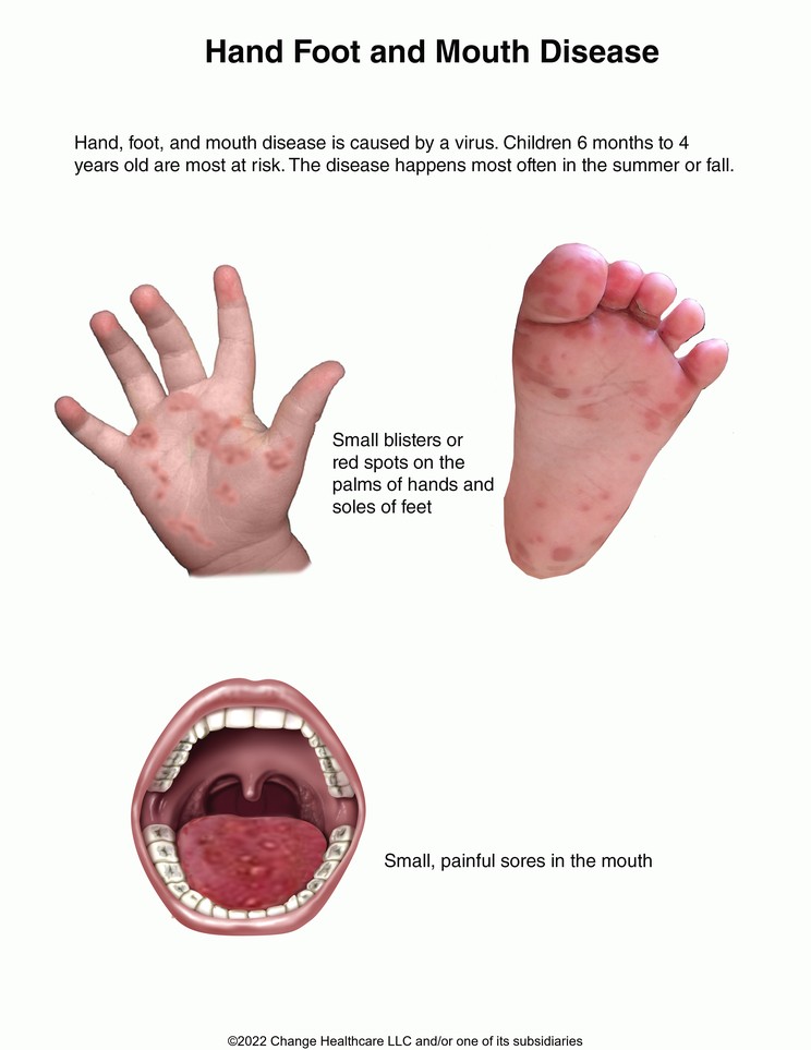 Hand, Foot, and Mouth Disease: Illustration