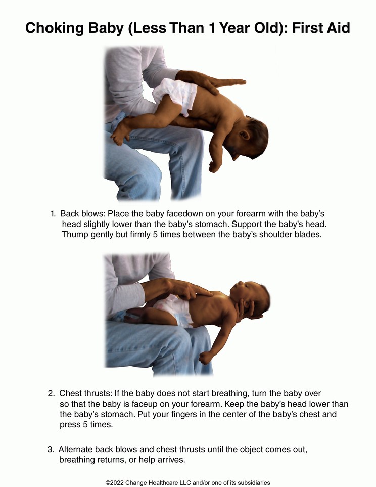Choking Baby (Less Than 1 year Old): First Aid: Illustration