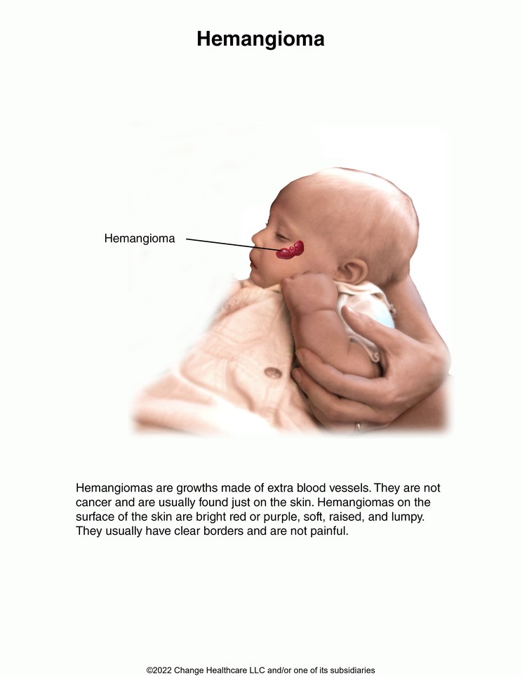 Hemangioma: Illustration