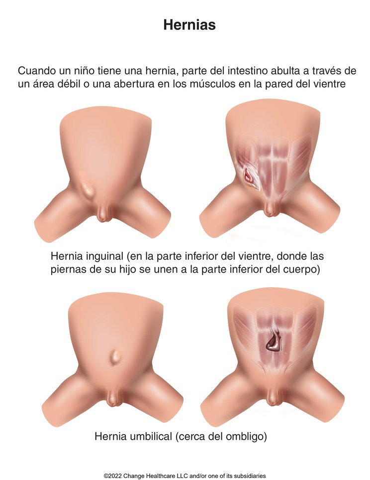 Hernia: Illustration