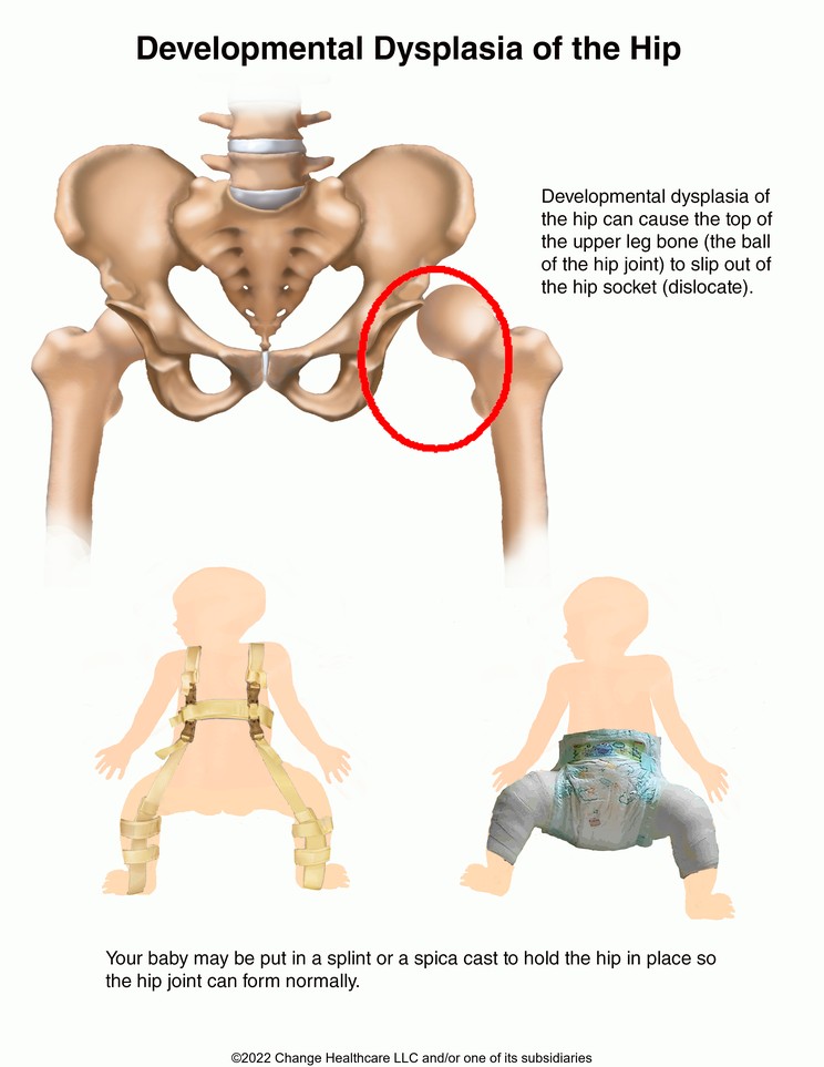 Developmental Hip Dysplasia: Illustration