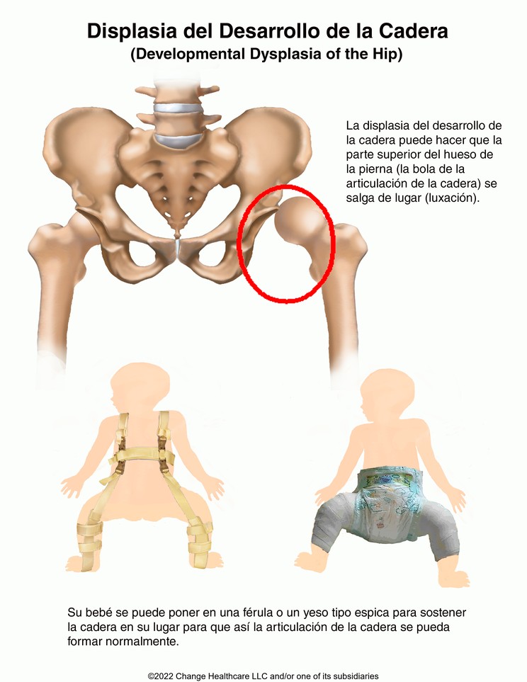 Developmental Hip Dysplasia: Illustration