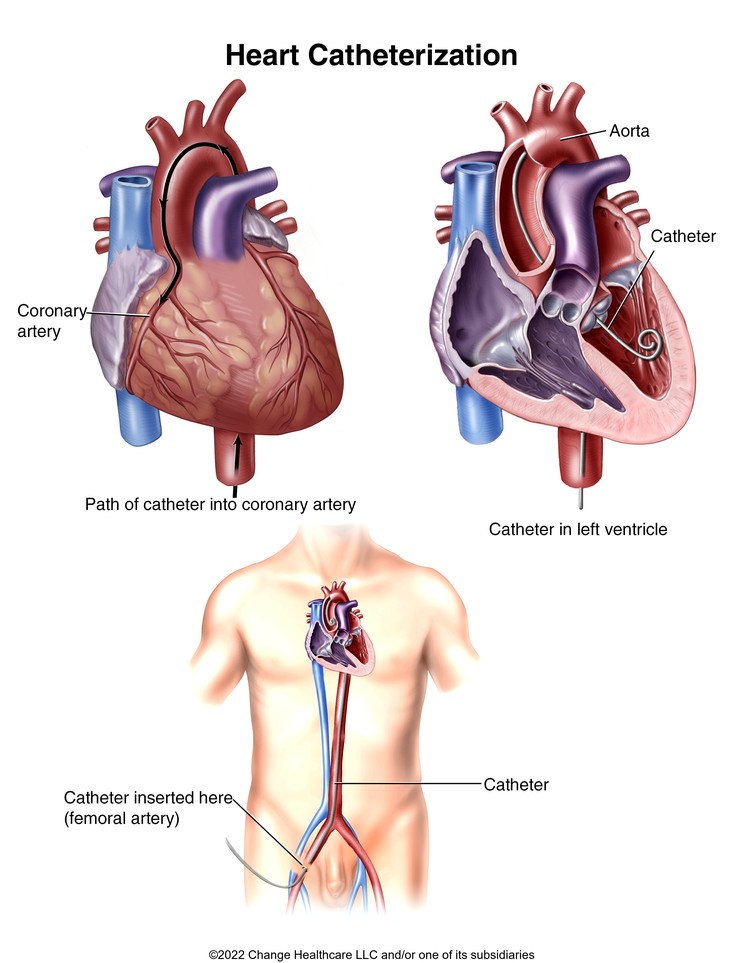 Heart Catheterization: Illustration