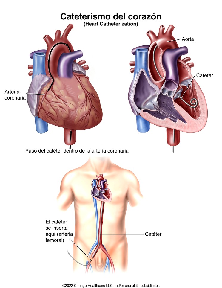 Heart Catheterization: Illustration