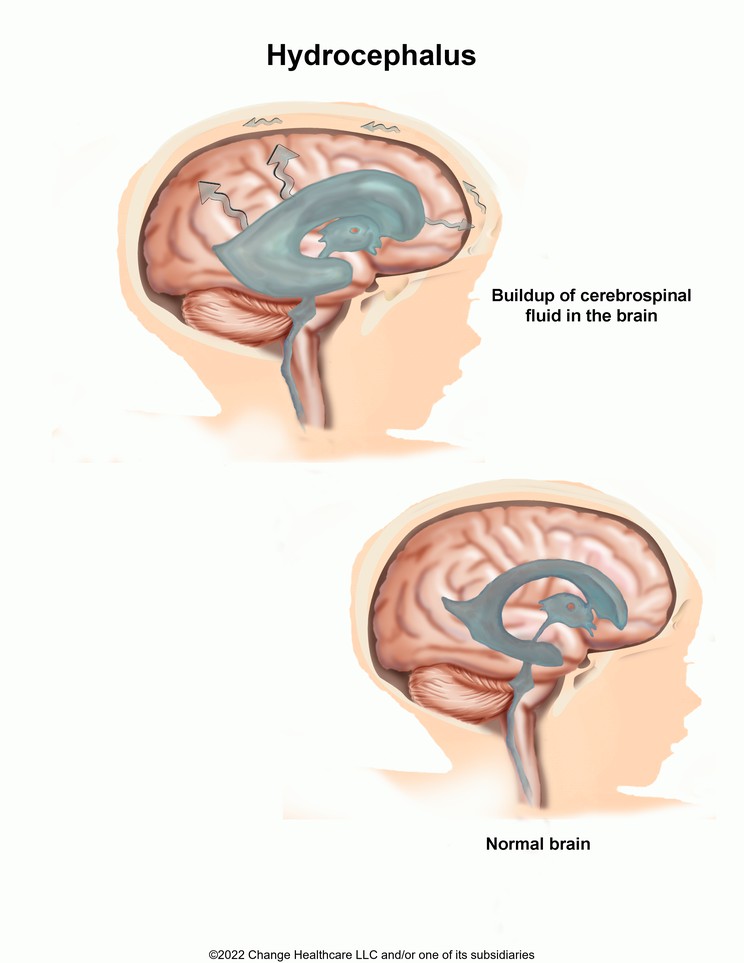 Hydrocephalus: Illustration