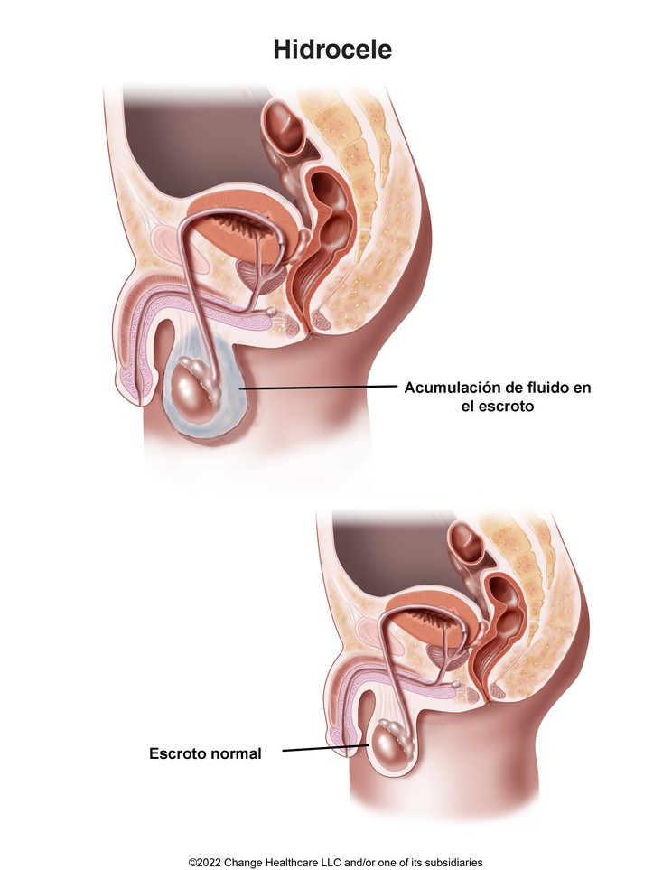 Hydrocele: Illustration