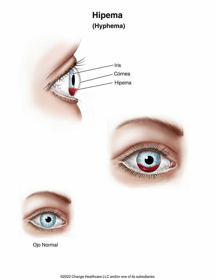 Hyphema: Illustration