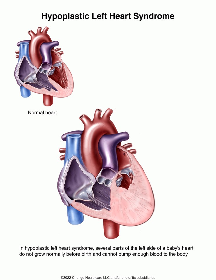 Hypoplastic Left Heart Syndrome: Illustration