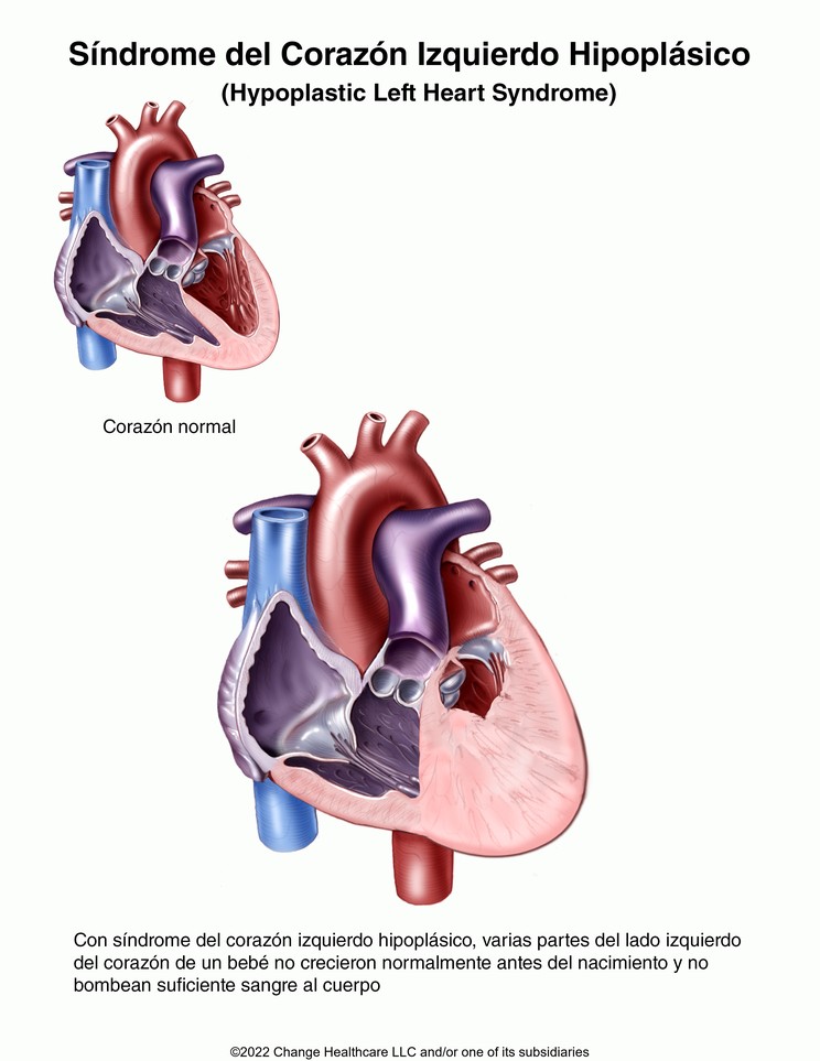 Hypoplastic Left Heart Syndrome: Illustration