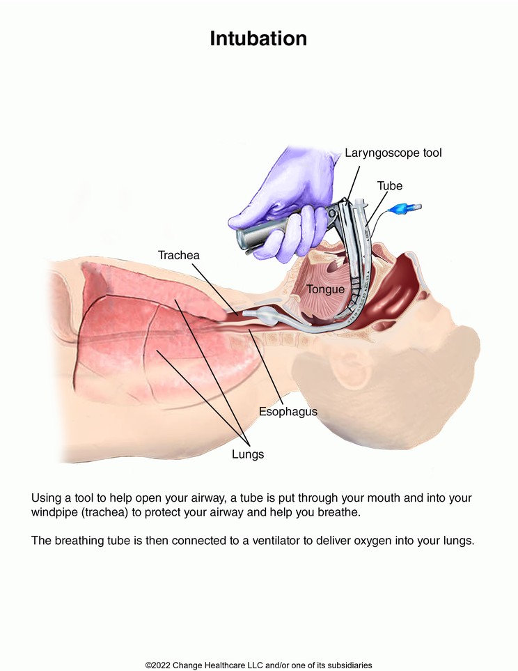Intubation: Illustration