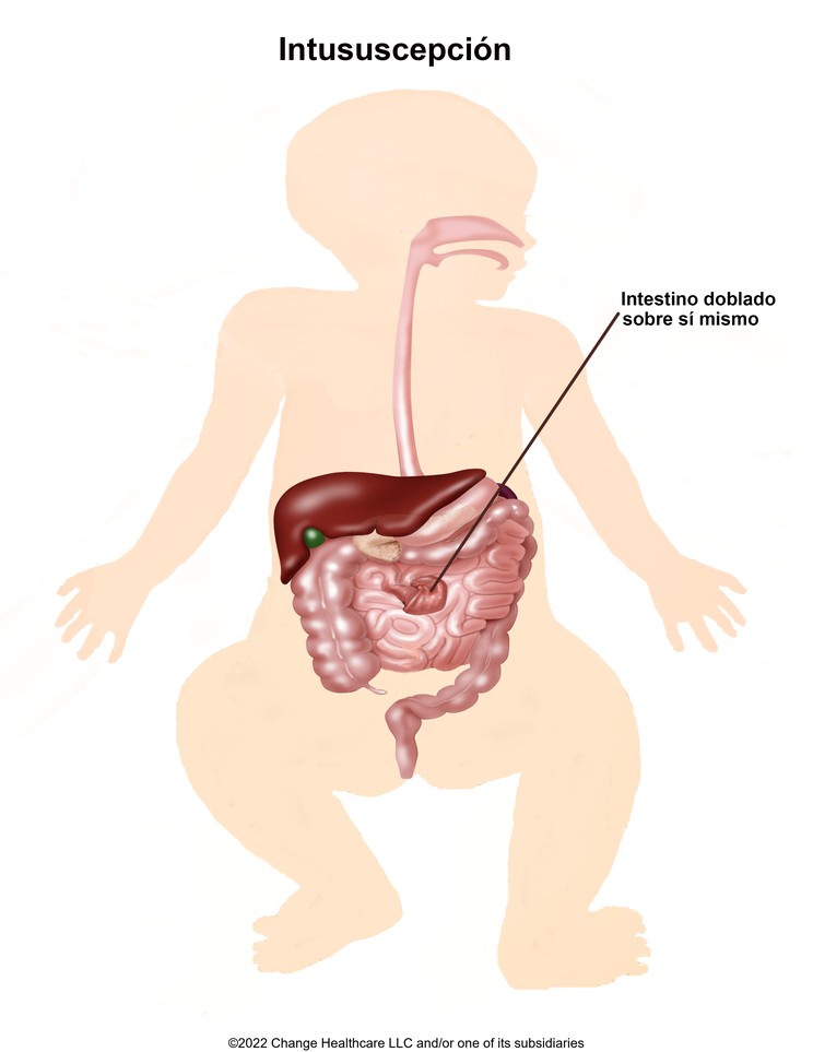 Intussusception: Illustration