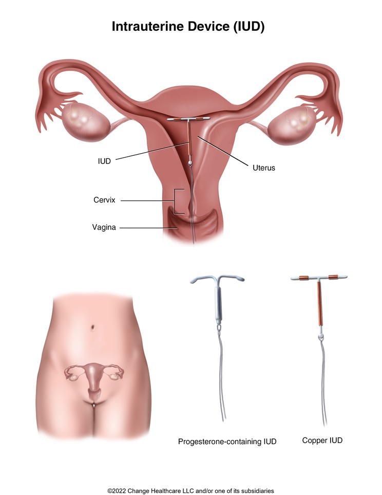 Intrauterine Device (IUD): Illustration