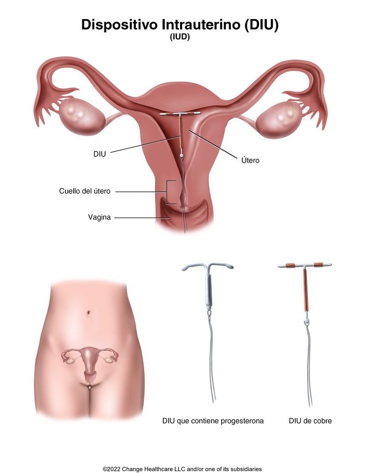 Intrauterine Device (IUD): Illustration