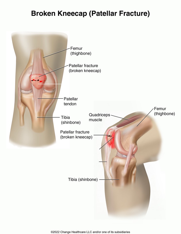 Kneecap (Patellar) Fracture: Illustration