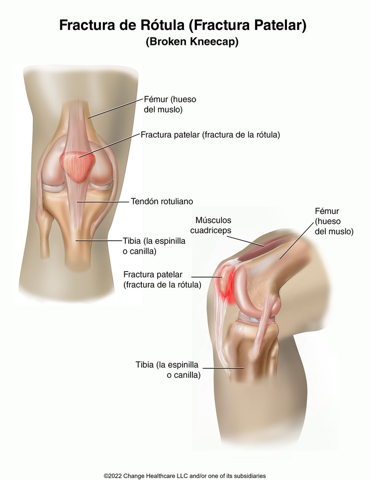 Kneecap (Patellar) Fracture: Illustration