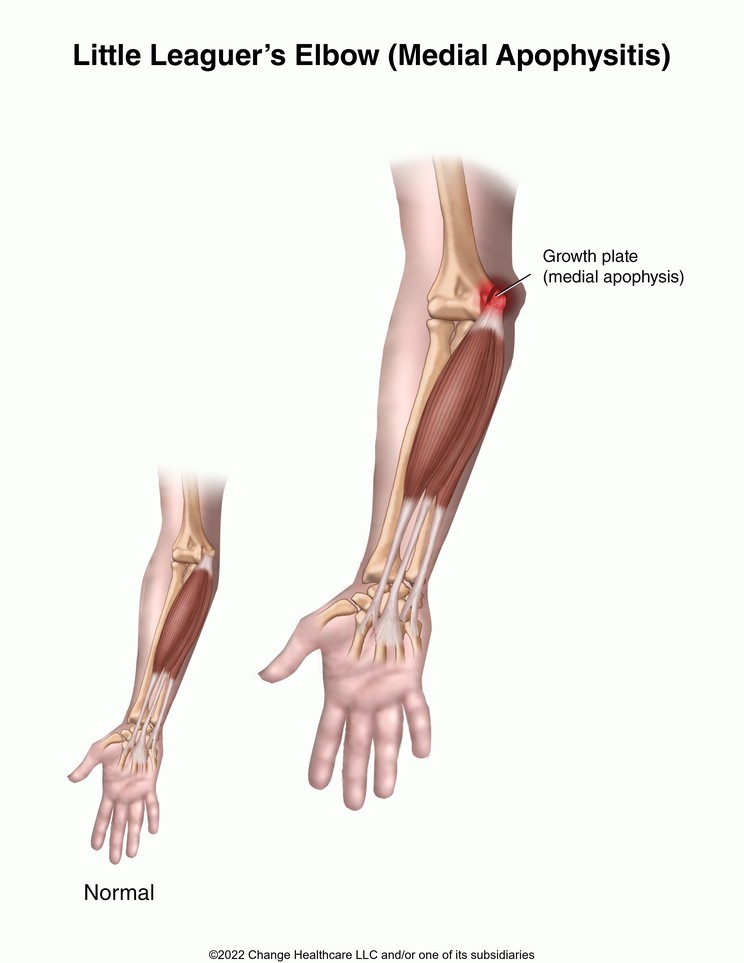 Little Leaguer's Elbow (Medial Apophysitis): Illustration